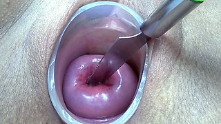 Prolapsed Cervix Lesbians at the same time